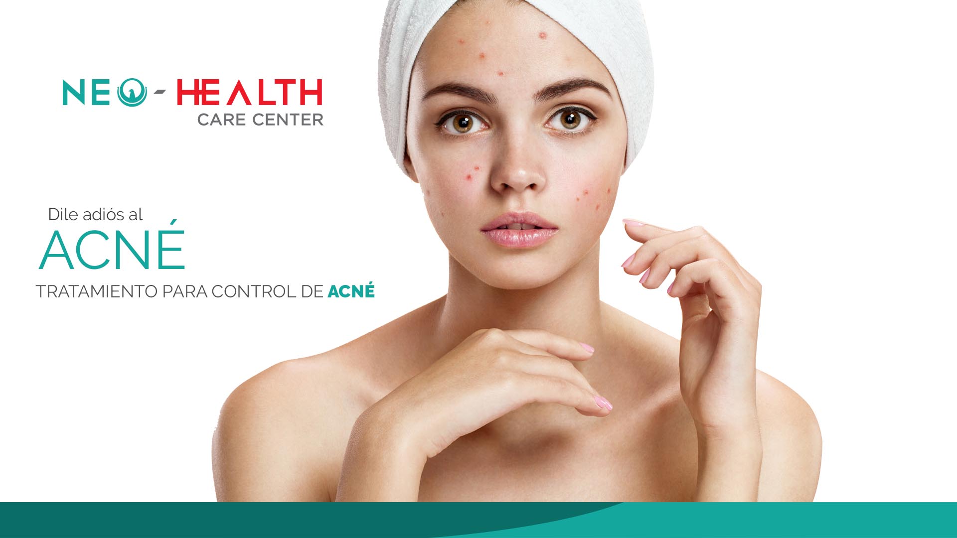 Tratamientos para el control de acné en queretaro
